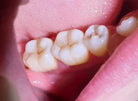 Лечение кариеса