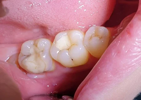 Лечение кариеса